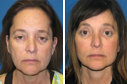 Before & After Photos